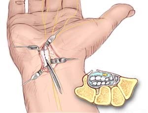 Hand nerve CTS surgery