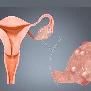 Ovarian cyst surgery