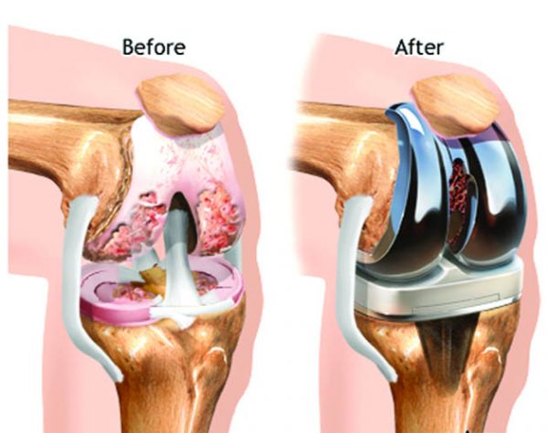 Knee joint replacement surgery