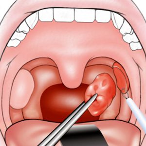Tonsil surgery