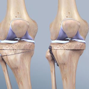 Knee osteotomy surgery