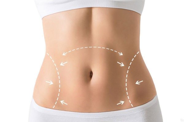 Abdominoplasty