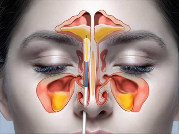 Endoscopic nose surgery